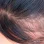 пересадка волос FUE-методом