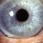 Лазная клиника лазерной экстракции катаракты фотография 2