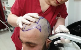 Медицинский центр по пересадке волос FueHair фотография 3
