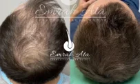 Клиника пересадки волос Dr. Эмрах Ата фотография 4