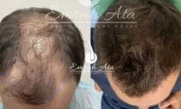Клиника пересадки волос Dr. Эмрах Ата фотография 13