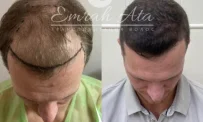 Клиника пересадки волос Dr. Эмрах Ата фотография 19