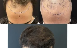 Клиника пересадки волос Dr. Эмрах Ата фотография 2