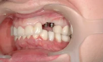 Лазерная стоматология на Рубцовской набережной фотография 6
